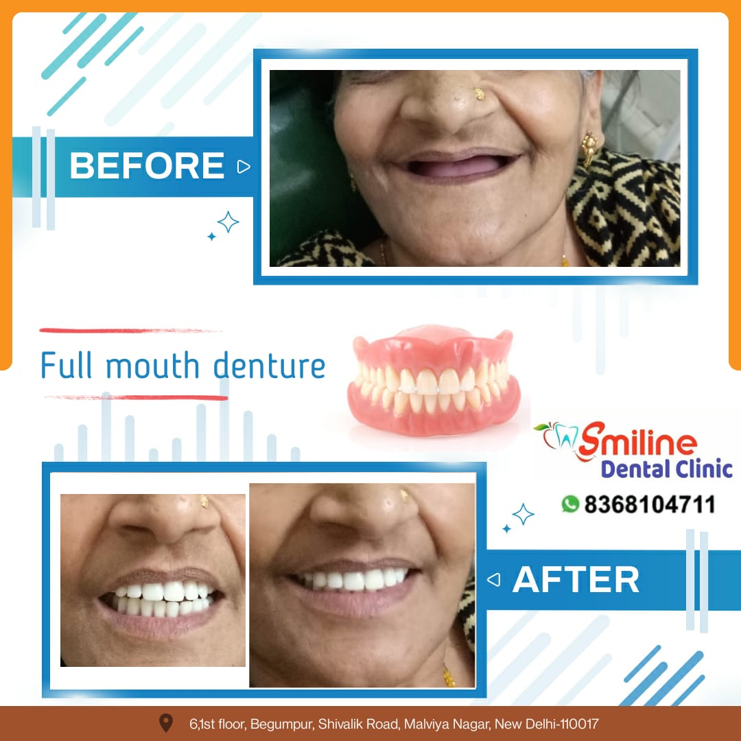 Smiline Dental Clinic smile transformation before after result Saket South Delhi